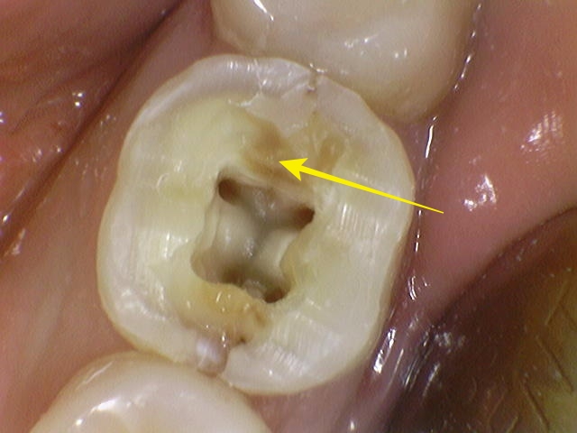 광희동 주변 치과 치아 크랙으로 인한 증상 신경치료 관련 이미지 6