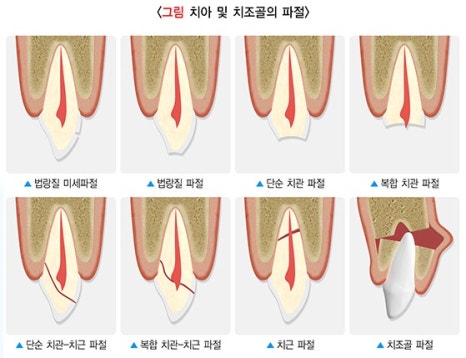 버티고개역 치과 앞니 외상에 따른 치료방법( 넘어져서 치아가 부러졌어요) 관련 이미지 1