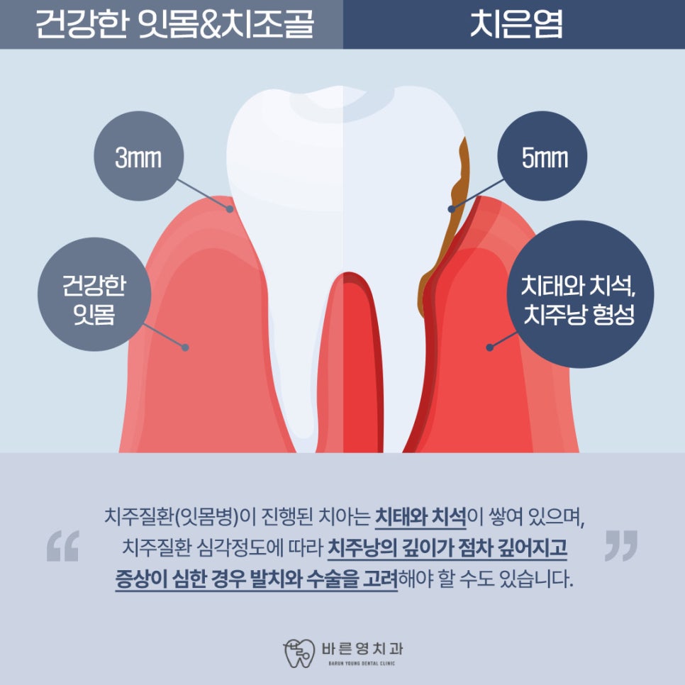 약수역 치과, 양치질 할때 피나고 냄새나는 잇몸병 관리 방법(워터픽, 먹는약) 관련 이미지 3