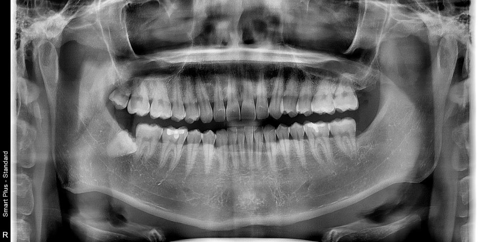 금호동 치과, 사랑니 때문에 주변 잇몸이 붓는 이유 (매복 사랑니 주변 치은염) 관련 이미지 3