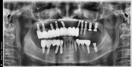 약수동 치과, 전체틀니 오래 쓰신분들 전체 임플란트 가능한가요??(치조골의 흡수양상과 모양) 관련 이미지 6