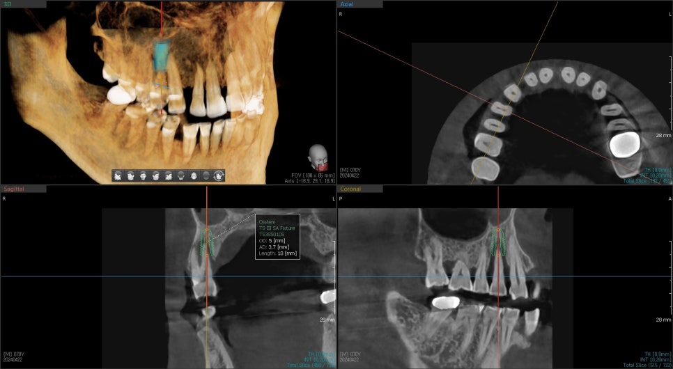 신당동 치과 씹을 때마다 아플 때 임플란트 치아의 문제 관련 이미지 3