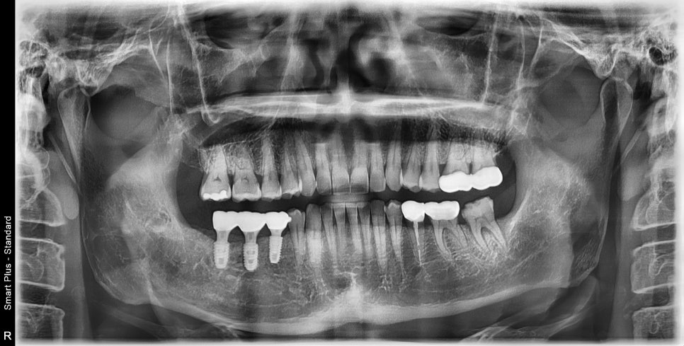 약수역 임플란트, 발치 후 임플란트 수술 언제 가능한가? 관련 이미지 4