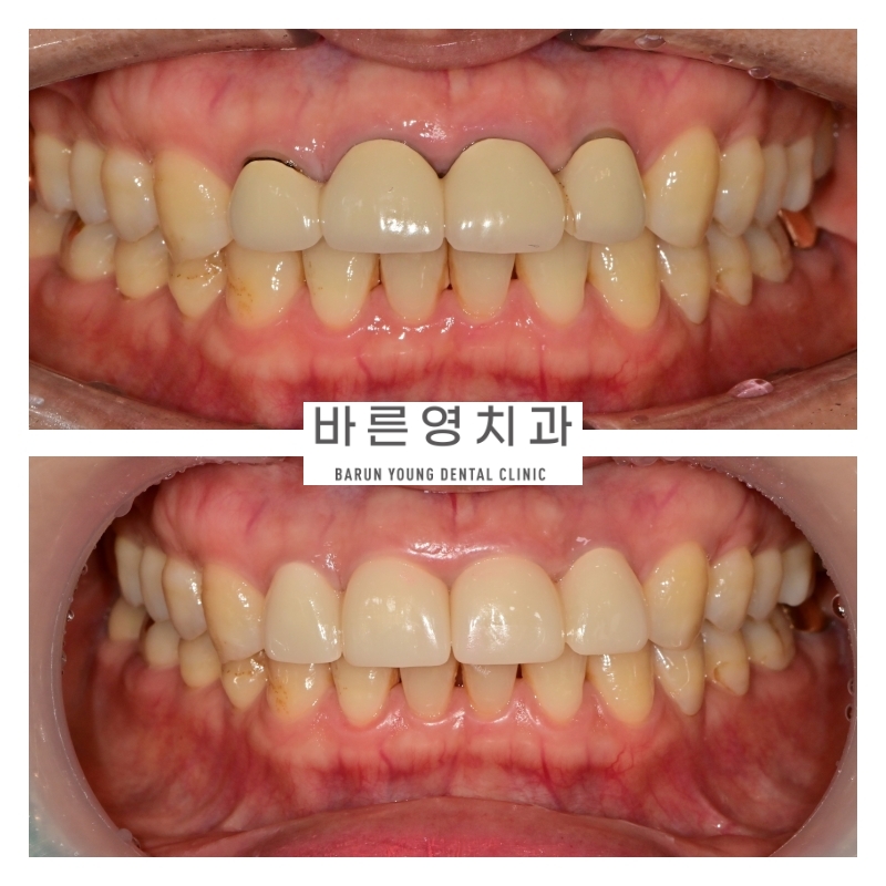 금호역치과 비율이 안 맞는 앞니 재보철치료 관련 이미지 5