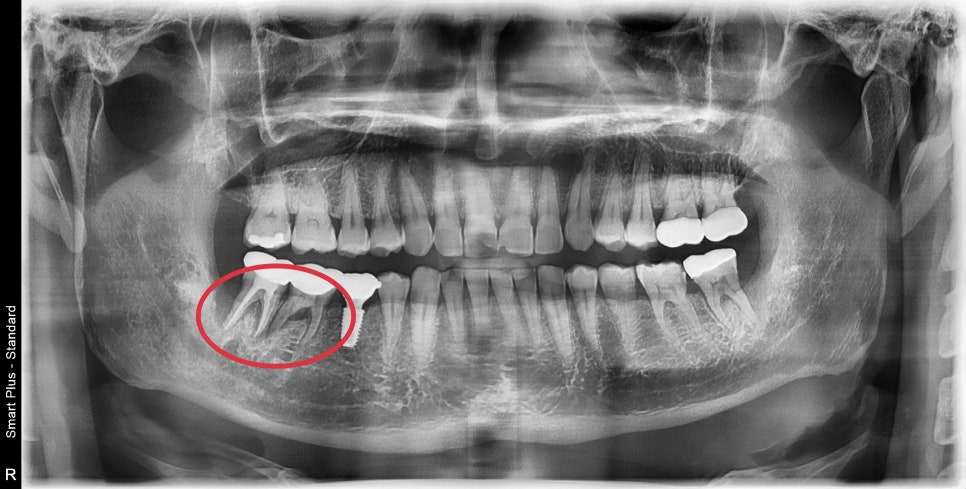 동대문 치아뿌리 염증 방치하면 치과 임플란트 기간에 영향을 줍니다 관련 이미지 2