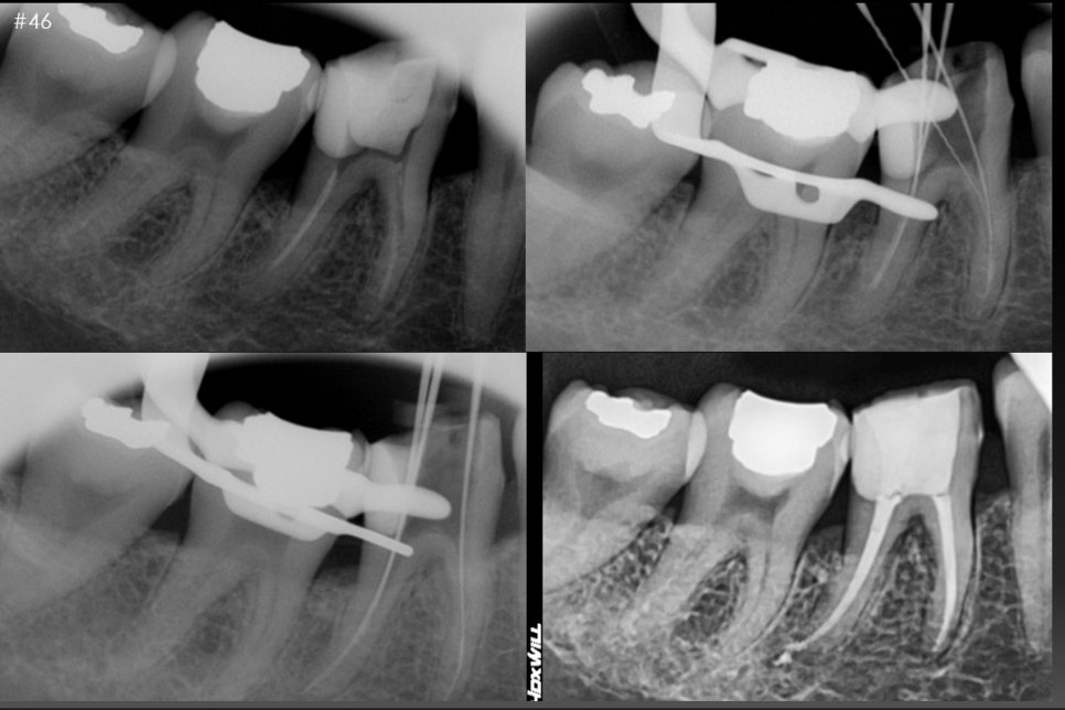 옥수동 치과, 신경치료 돼있는 치아 잇몸의 염증, 고름주머니가 생겼을 때 약을 먹어도 안 가라앉아요. ( 생기는 원인과 치료방법) 관련 이미지 4