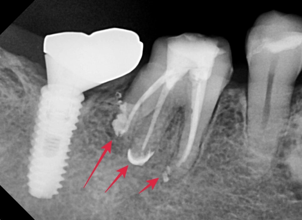 옥수동 크라운치료된 통증 있는 치아의 (재)신경치료 과정 관련 이미지 5