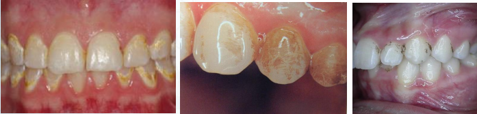 약수역 치과, 치아 미백 1회 방문으로 효과가 있을까?(feat. 원데이 미백) 관련 이미지 2
