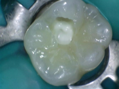 약수역치과 깊은 충치 신경치료 없이 치료하는 방법( MTA치료 ) 관련 이미지 6