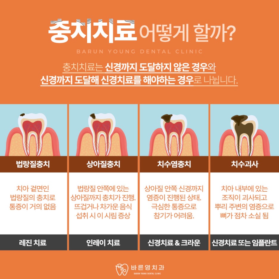 약수역치과 시리고 아픈 치아 충치치료 미루지 말고 빠르게 관련 이미지 7