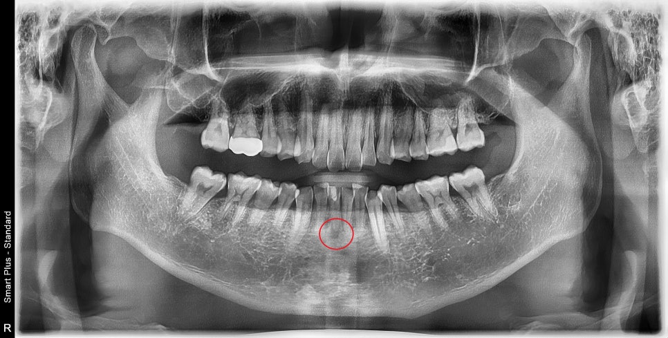약수역 치과, 신경치료 시작 후 장기간 중단되었을 때 생길 수 있는 증상은?? 관련 이미지 1