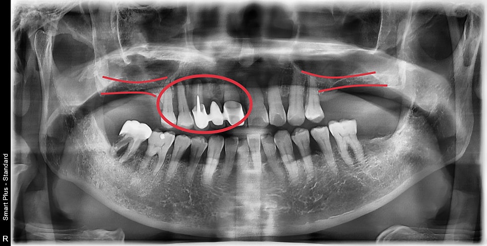 신당역 임플란트 풍치, 심한 치주염인 경우 치과에서 치료 순서 관련 이미지 2