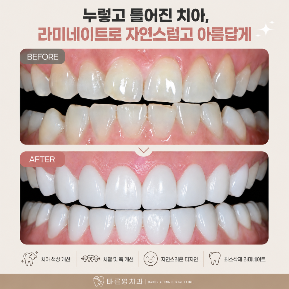약수역 치과 라미네이트 vs 올세라믹, 어떤 치료가 더 좋을까요? 관련 이미지 1