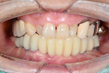 Full-Mouth Implants at Yaksu Station: Can You Have Teeth Immediately After Surgery? image 2