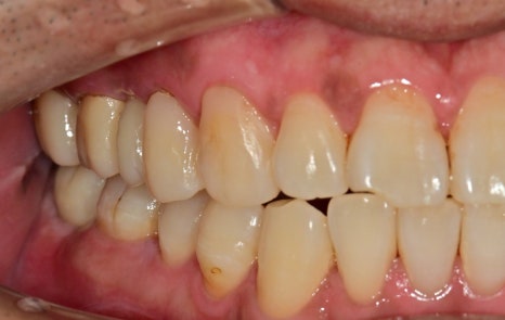 장충동 주변 치과 오래된 충치, 빠진 치아 부위 치료 방법 관련 이미지 7