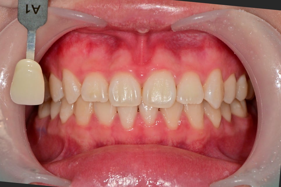 약수역 치과, 치아 미백 1회 방문으로 효과가 있을까?(feat. 원데이 미백) 관련 이미지 8