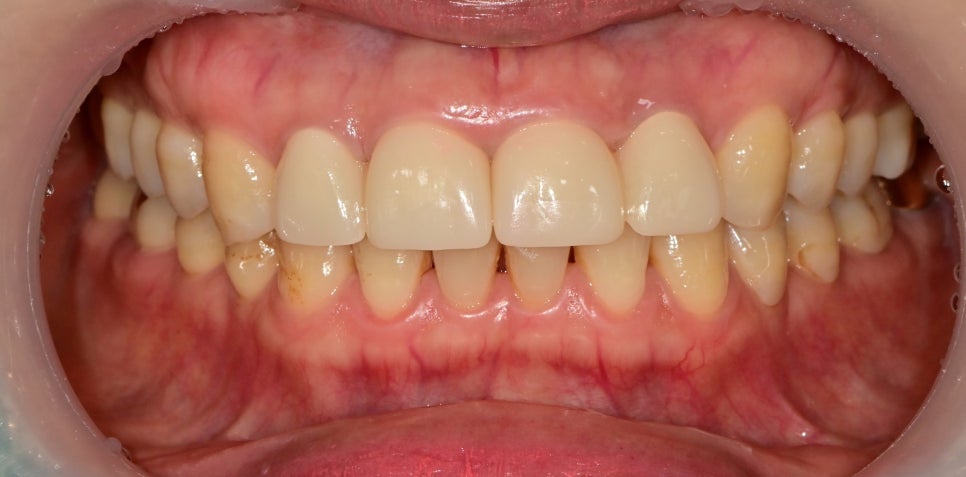 금호역치과 비율이 안 맞는 앞니 재보철치료 관련 이미지 4
