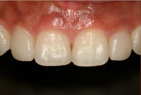 청구동 치과 앞니 라미네이트를 하는 이유 관련 이미지 2