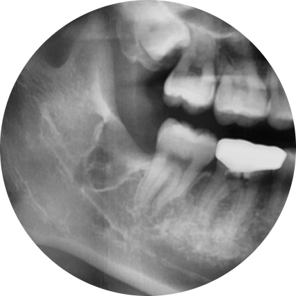 옥수역치과, 사랑니발치 사후관리까지 신경써야 관련 이미지 6