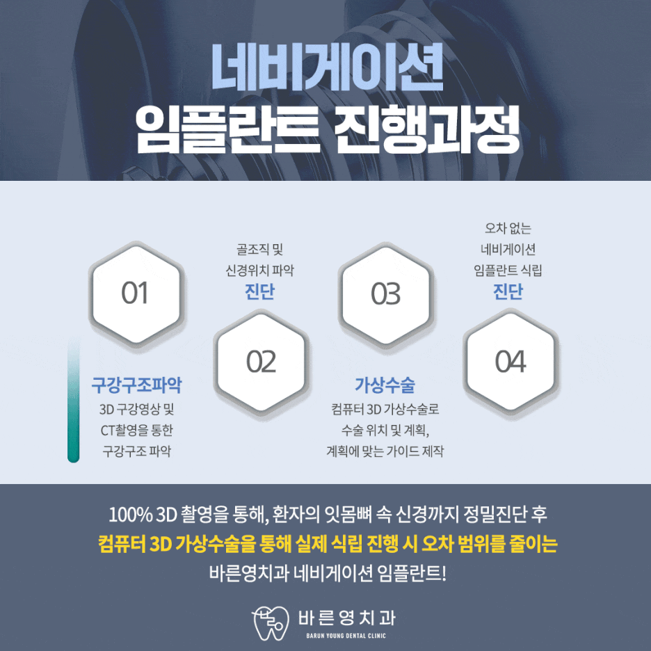 금호역치과 미리 경로 알고 식립하는 네비게이션 임플란트 관련 이미지 10
