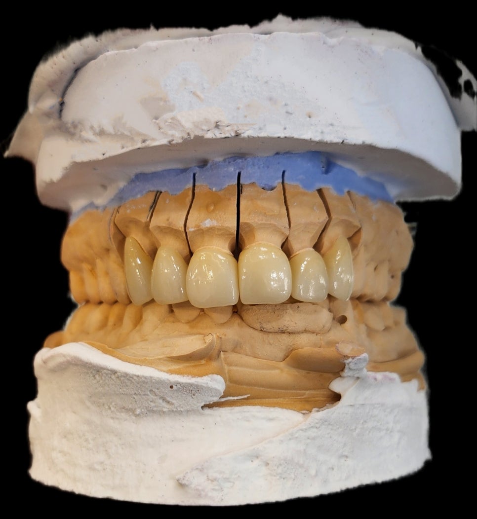 신당동치과 심미보철을 이용한 고른 앞니 만들기 관련 이미지 5