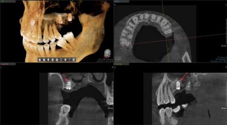 신당동 치과 오래전 빠진 치아 상태에서 임플란트 수술(상악동 거상술) 관련 이미지 9