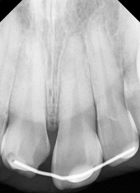 버티고개역 치과 앞니 외상에 따른 치료방법( 넘어져서 치아가 부러졌어요) 관련 이미지 7