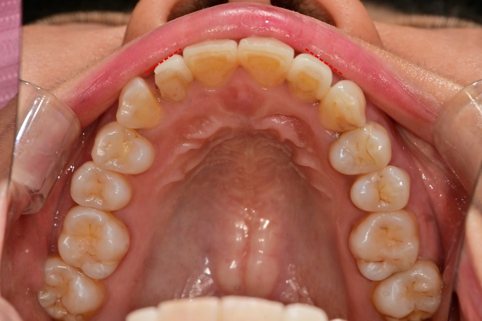 동대입구역 주변 치과 라미네이트가 깨지는 이유 관련 이미지 2