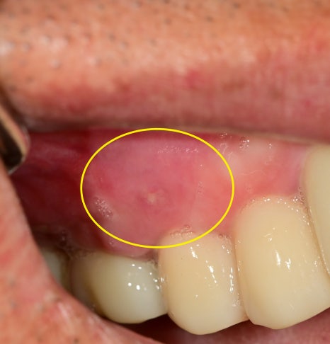 금호동 치과 신경치료된 치아 주변 염증 방치하면 안 되는 이유(발치후 임플란트) 관련 이미지 7