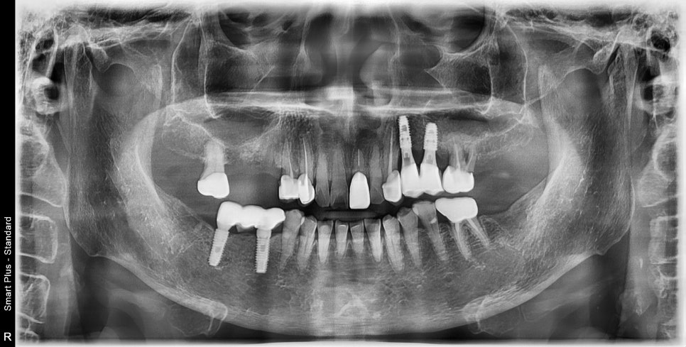 신금호 치과 , 틀니를 오래 쓰면 치아에 생기는 문제점 관련 이미지 4