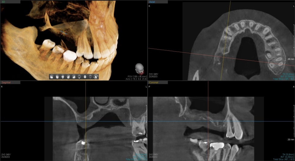 Yak-su Station Dental Clinic: When Is a Sinus Lift Necessary for Implants? image 8
