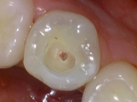 약수역치과 깊은 충치 신경치료 없이 치료하는 방법( MTA치료 ) 관련 이미지 4