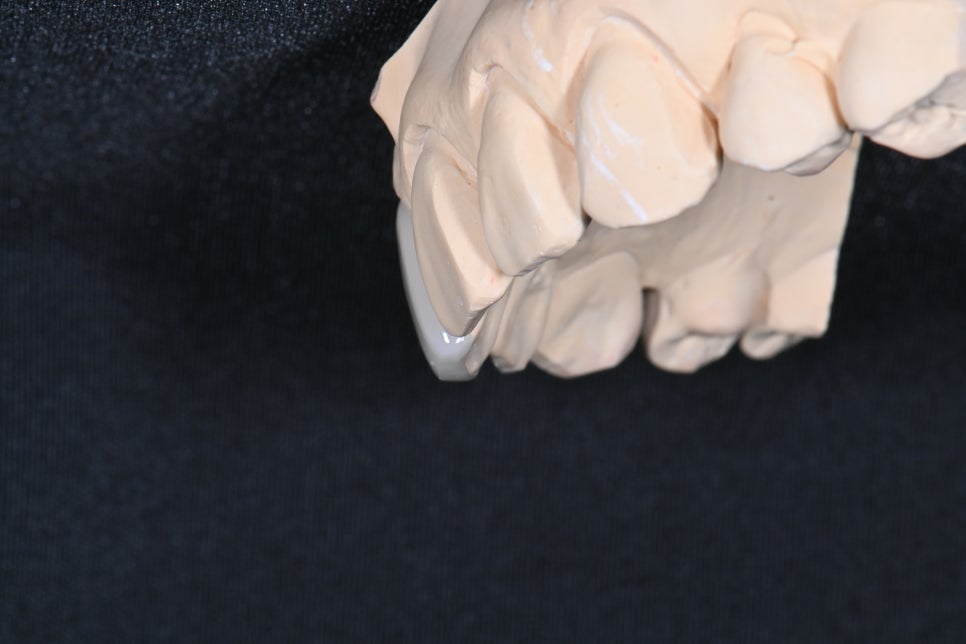 동대문 무삭제라미네이트 과거 교정한 치아가 웃을 때 안 보여 스트레스일 때 관련 이미지 3