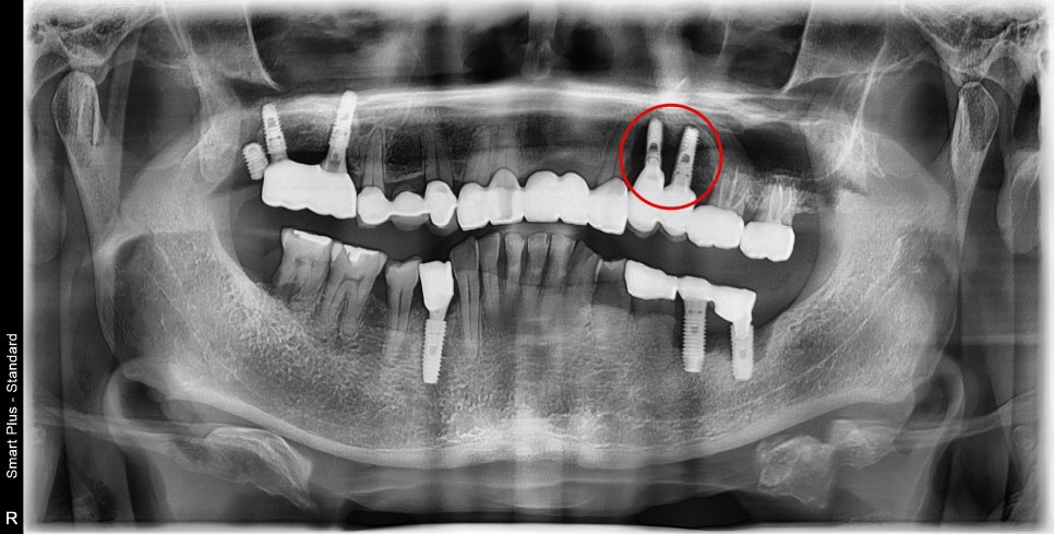 신당동 치과 씹을 때마다 아플 때 임플란트 치아의 문제 관련 이미지 7