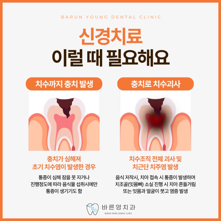 약수역치과 시리고 아픈 치아 충치치료 미루지 말고 빠르게 관련 이미지 9