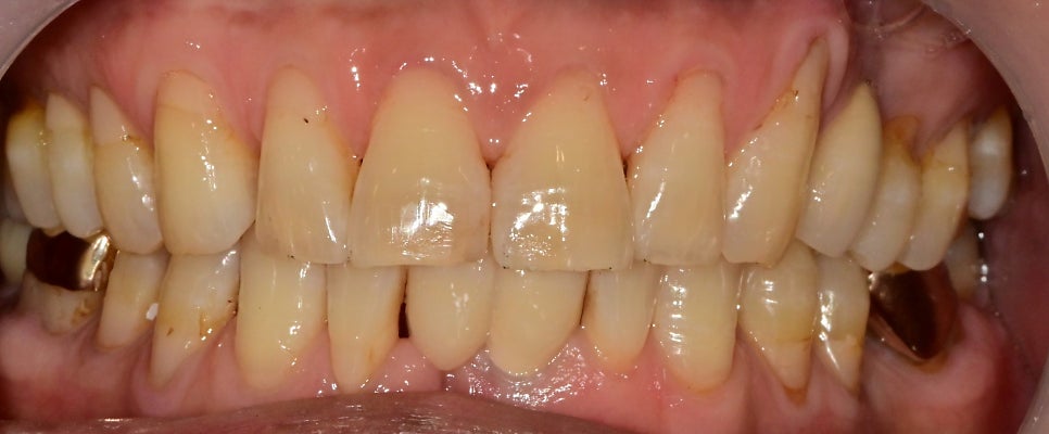 성동구 옥수동 치과 앞니 임플란트수술 즉시 임시치아 제작(구강스캐너를 이용한 수술절차) 관련 이미지 8