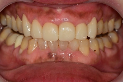 신당동치과 심미보철을 이용한 고른 앞니 만들기 관련 이미지 6