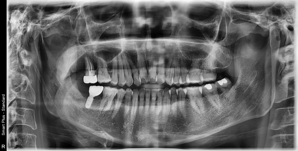 신당동주변치과 치아가 오랜 시간 없을 경우 주변 치아에 미치는 영향 관련 이미지 3