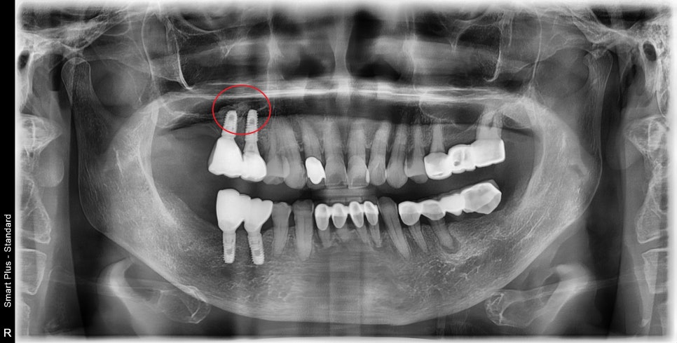 약수역 치과, 임플란트는 치아 개수마다 꼭 필요한가요?( 임플란트 진단이 모두 다른 이유??) 관련 이미지 2