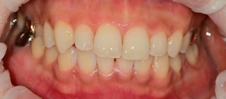 약수역치과 벌어진 앞니(치간이개) 레진을 이용한 치료방법 관련 이미지 6