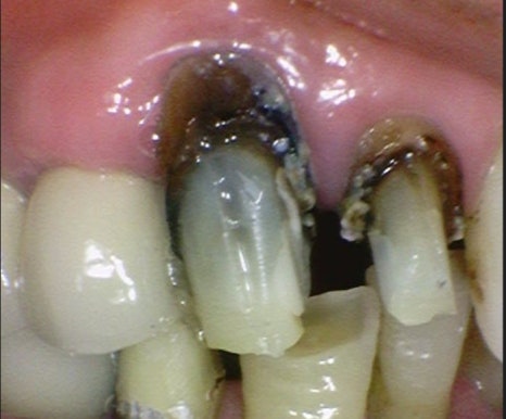 금호역 치과, 오래된 크라운을 교체 시기와 교체 시 주의해야 할 사항( 2차 충치로 인한 약해진 치아 치료) 관련 이미지 2