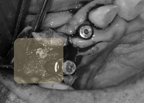 신당역 임플란트 풍치, 심한 치주염인 경우 치과에서 치료 순서 관련 이미지 8