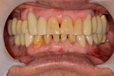 금호역 치과, 오래된 크라운을 교체 시기와 교체 시 주의해야 할 사항( 2차 충치로 인한 약해진 치아 치료) 관련 이미지 4