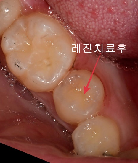 약수역치과 깊은 충치 신경치료 없이 치료하는 방법( MTA치료 ) 관련 이미지 7