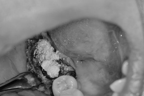 신금호역 주변 치과 치아가 빠진 후 시간이 오래 지나면 생기는 문제점 관련 이미지 6