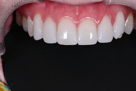 약수역 치과 라미네이트의 완성은 관리에서 시작합니다 관련 이미지 5