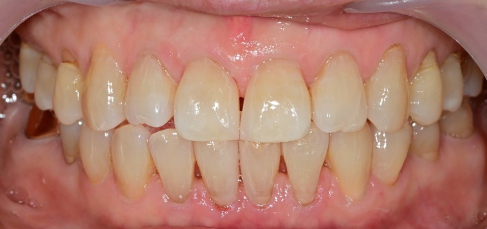 약수역 치과 벌어진 앞니, 금간앞니(크랙) 레진을 이용한 치료 관련 이미지 2