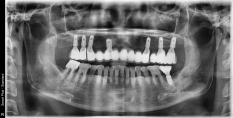 금호역 치과, 전체 틀니 대신 전체 임플란트로 가는 기간(식립위치의 선정의 중요성) 관련 이미지 5