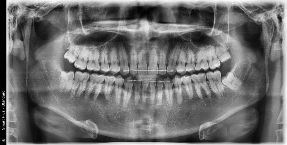 약수역치과, 턱관절 관련 질환(보톡스 치료) 관련 이미지 2