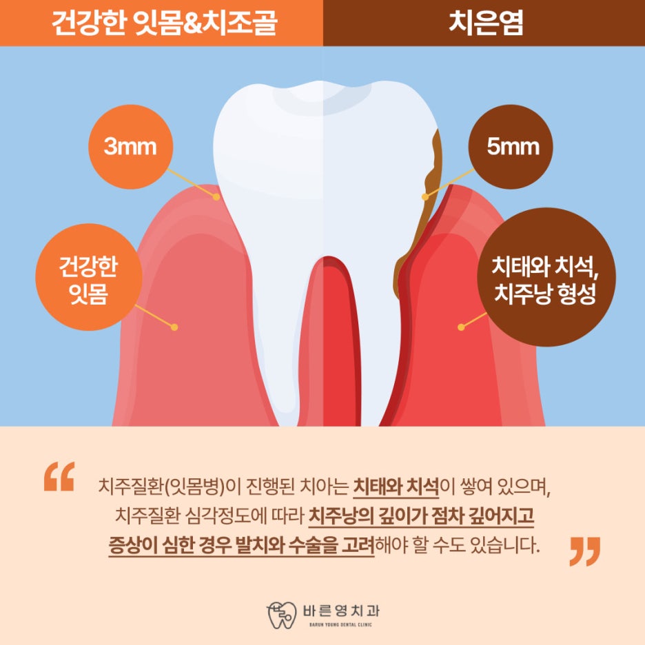 충무로치과 스케일링, 자꾸 피나고 찌릿하는 잇몸통증 이유는 치주질환? 관련 이미지 4
